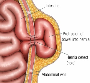 Hernia surgery image